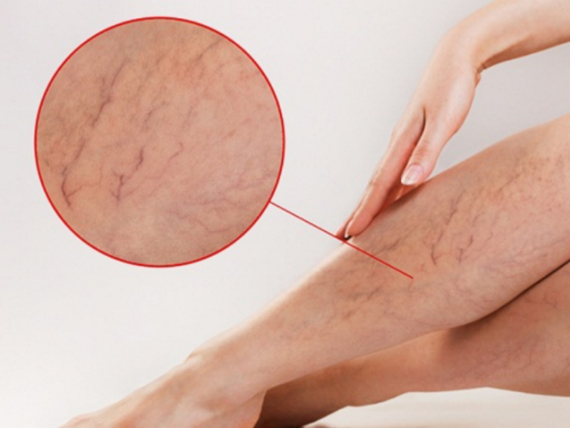 3 dạng bệnh suy giãn tĩnh mạch thường gặp