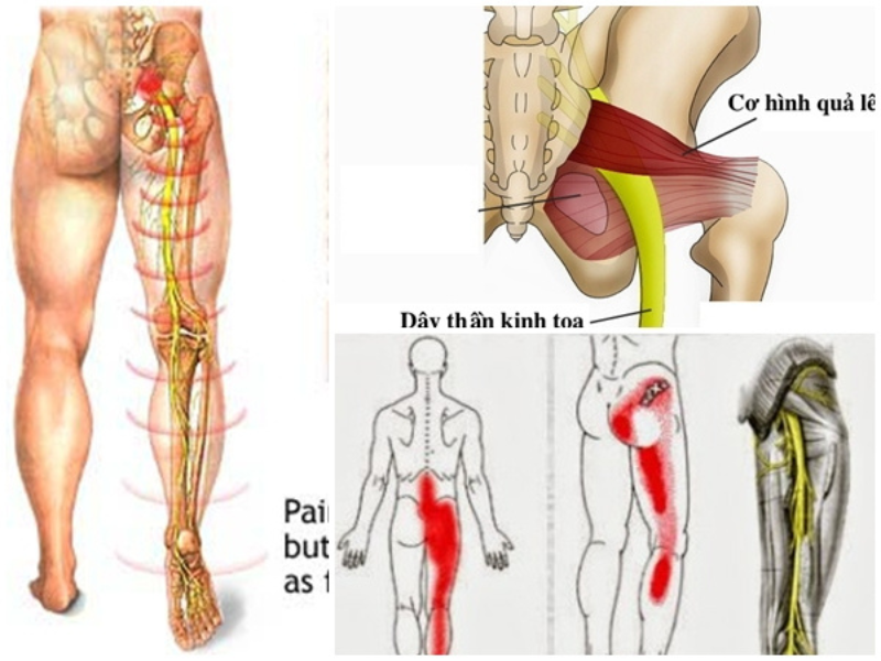 Triệu chứng thường gặp của người đau thần kinh tọa