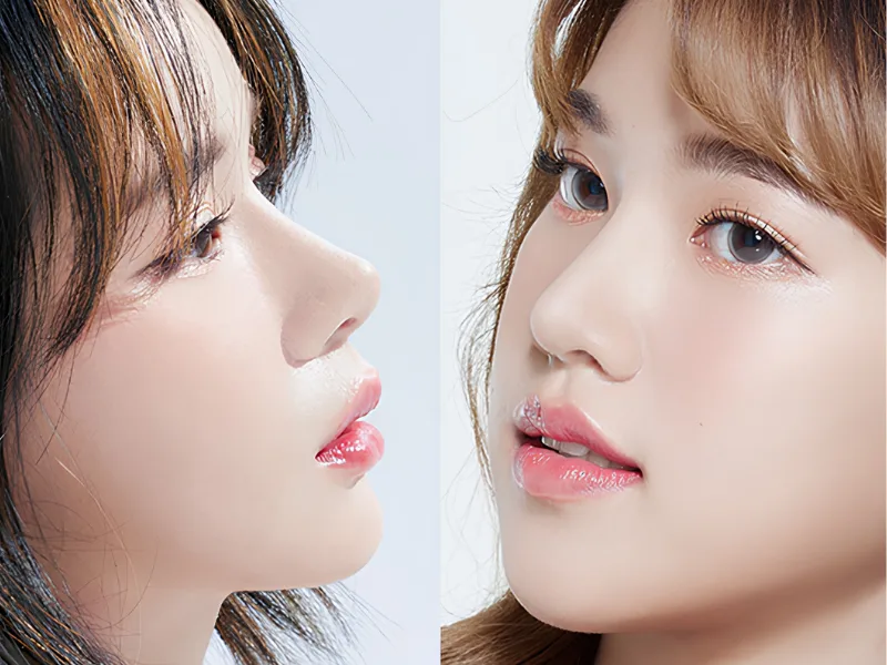 Mũi ở tuổi dậy thì có còn thay đổi không?