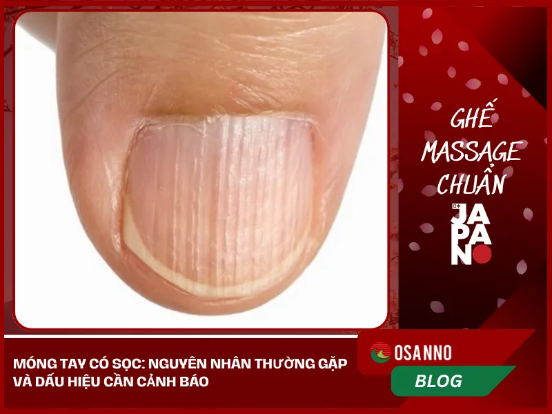 Móng tay có sọc: nguyên nhân thường gặp và dấu hiệu cần cảnh báo